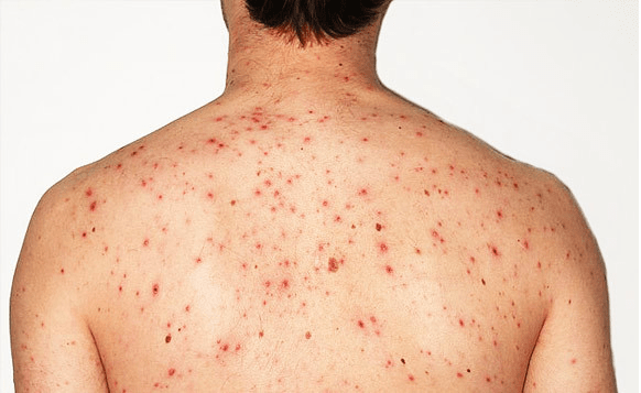 Wajah Sudah Glowing tapi Jerawat Badan Masih Bandel? Ini Penyebab yang Sering Diabaikan!