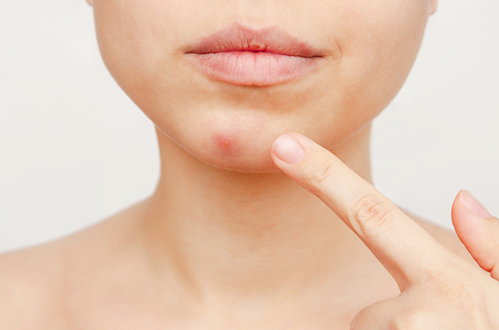 Treatment untuk Jerawat di Dagu